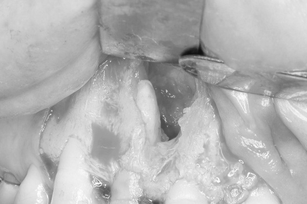 外科的歯内療法とは